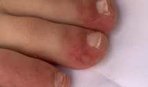 De calafrios e rosto azulado a dedos de Covid: confira outros sintomas da Covid-19