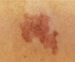 Câncer de pele não melanoma deve atingir 1.830 paraibanos este ano