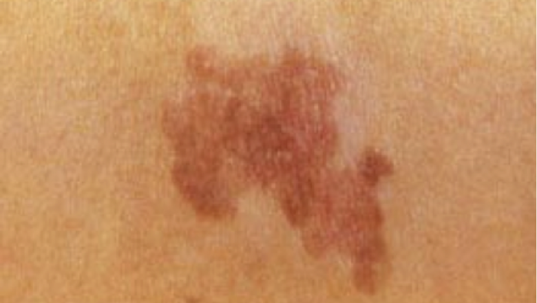 Câncer de pele não melanoma deve atingir 1.830 paraibanos este ano