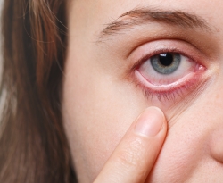 Conjuntivite viral: considerada ‘gripe do olho’, infecção pode levar à cirurgia