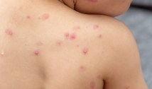 Paraíba acumula 76 casos confirmados de Monkeypox