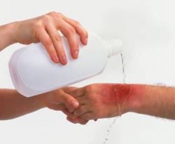 Substâncias inadequadas em queimaduras podem agravar o dano causado à pele, afirma dermatologista 