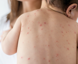 Vacinação contra sarampo inicia segunda-feira para crianças menores de 5 anos 
