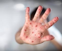 Saúde alerta a população para atualização da vacina contra o sarampo 