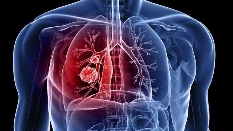 Por dia, três paraibanos descobrem que têm tuberculose e especialista afirma que doença não só atinge ‘grupo de risco’